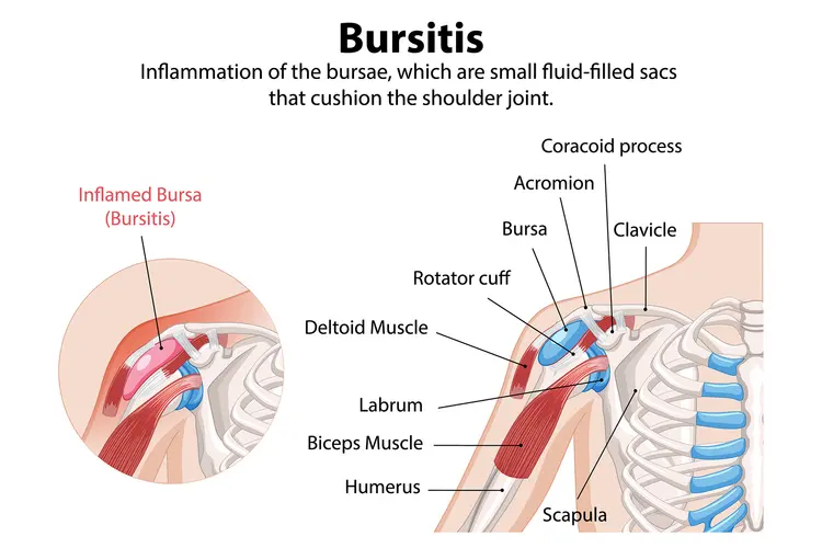 illustration of bursitis