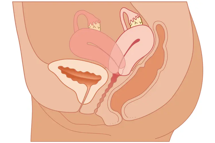 photo of tilted uterus