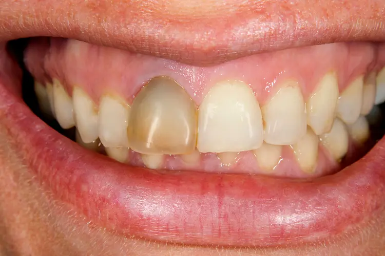 Image of Discolored Tooth
