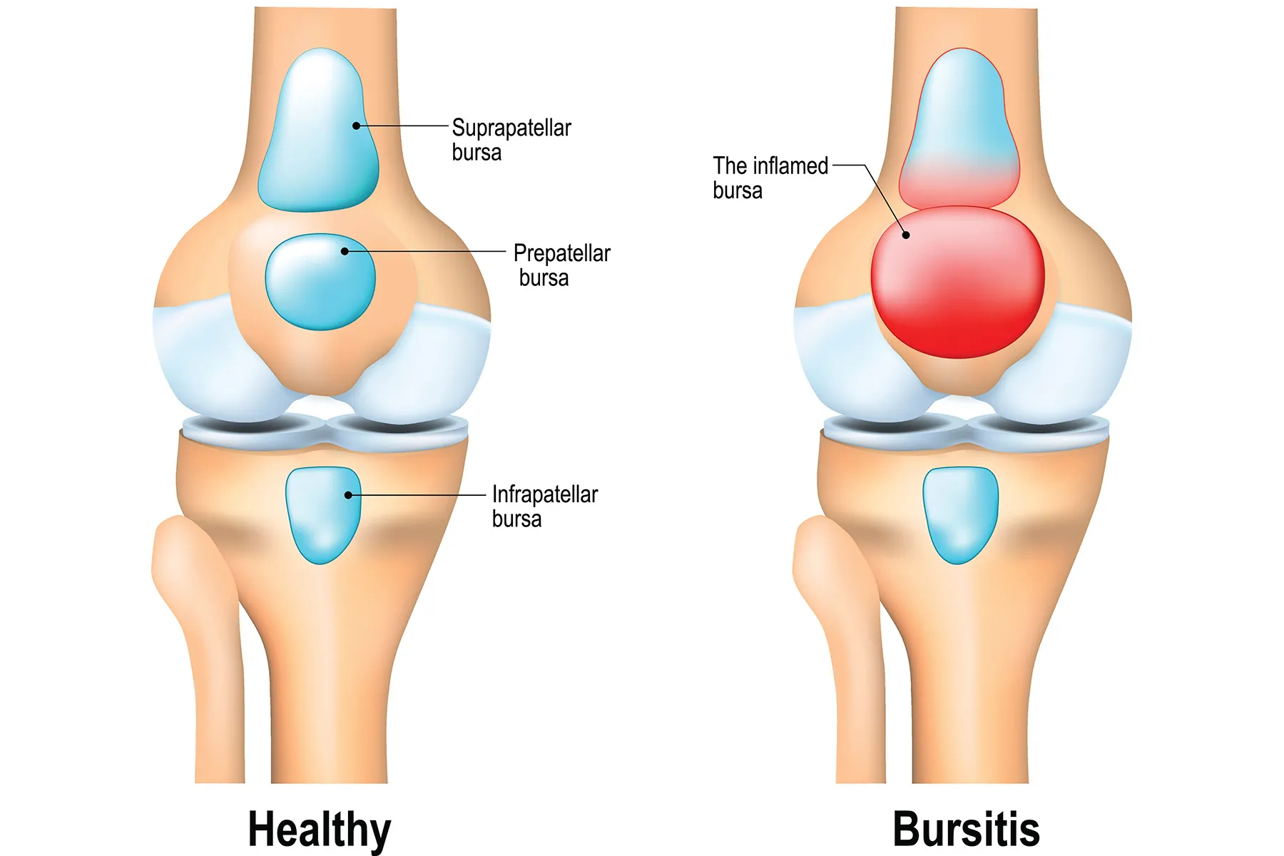 Prepatellar Bursitis Knee Bursitis: All You Need To Know