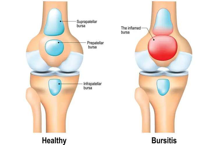 photo of knee bursitis