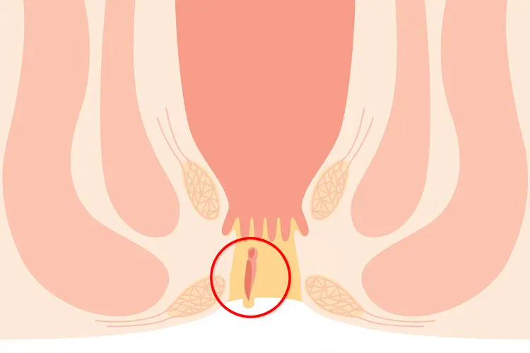 photo of perianal skin tag