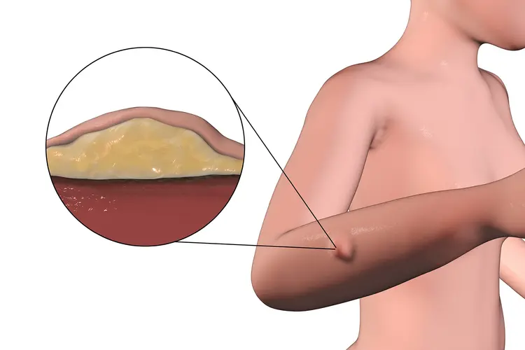 photo of lipoma on arm