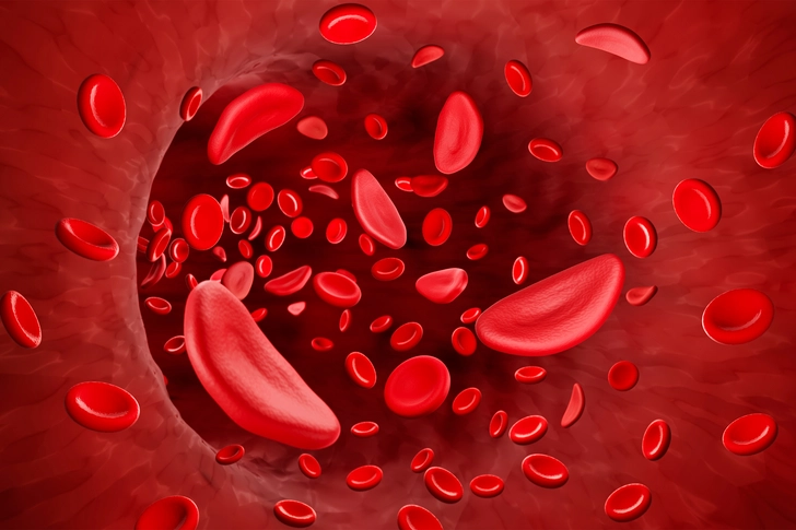 Sickle Cell Anemia