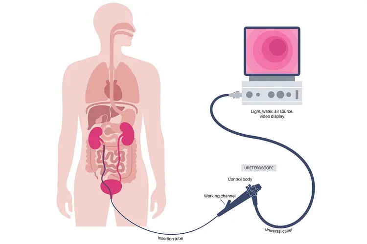 photo of ureteroscopy