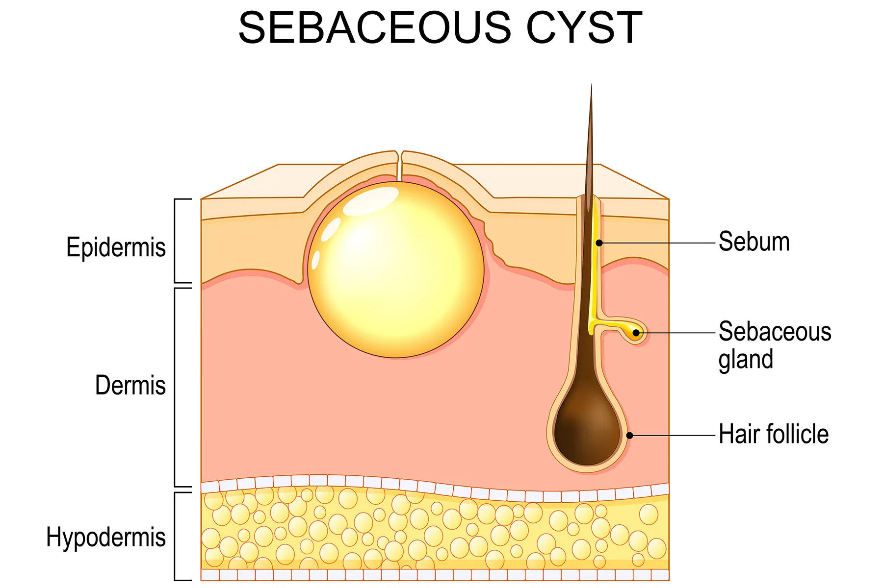 Diagram showing a cross-section of skin with a sebaceous cyst, hair follicle, and sebaceous gland.