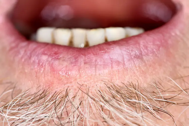 photo of Actinic cheilitis