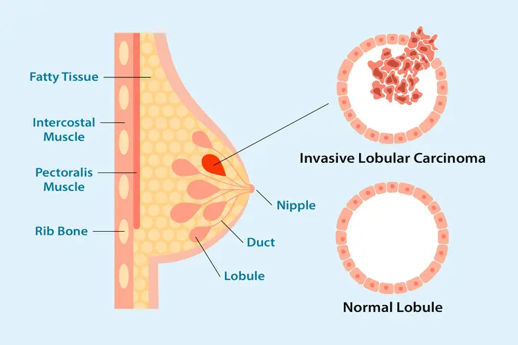 illustration of Invasive lobular carcinoma