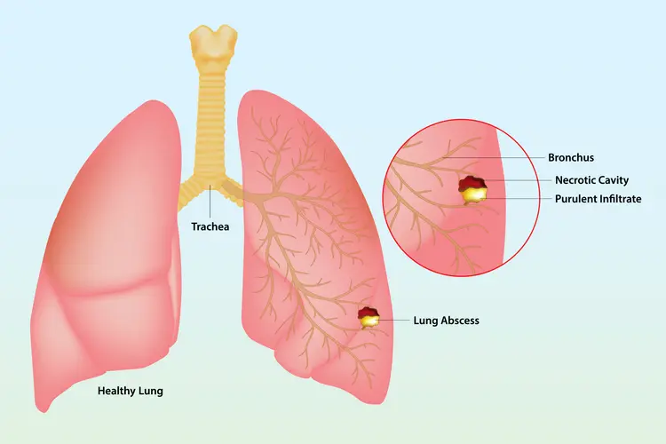 illustration of lung abscess anatomy
