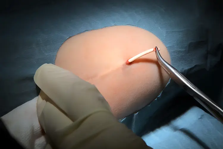 photo of contraceptive implant removal