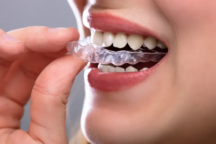 fitting invisible aligners on teeth