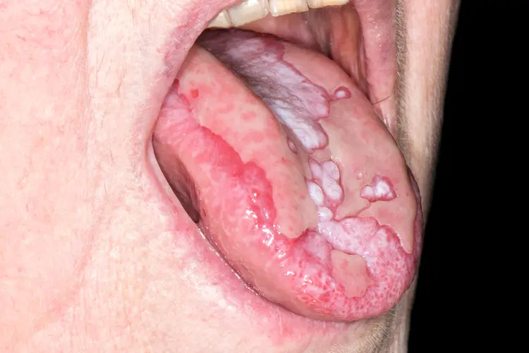 photo of oral lichen planus