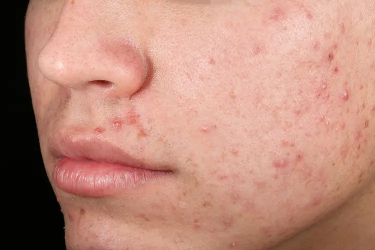 Photo of young man with acne and post-inflammatory erythema
