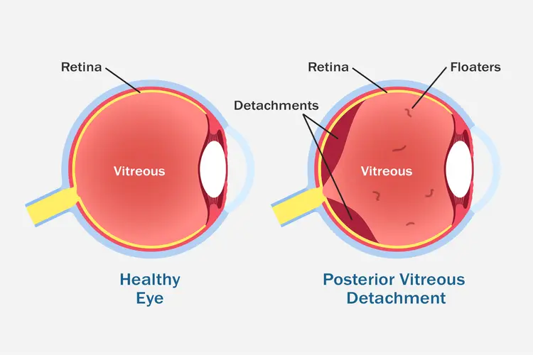 photo of posterior vitreous detachment