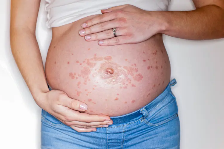 photo of puppp rash on pregnant belly