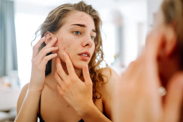 photo of woman checking facial acne in mirror