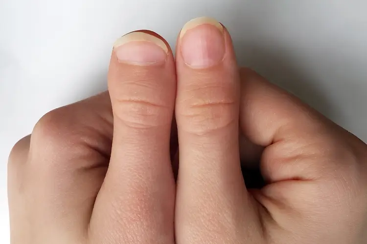 photo of brachdactyly in one thumb