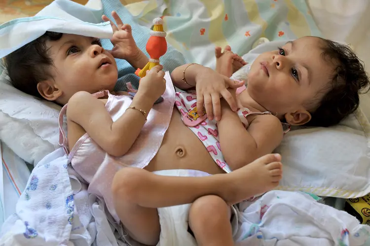 photo of conjoined twins