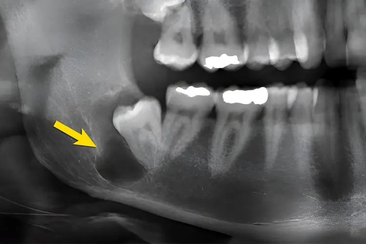 X-ray photo of dentigerous jaw cyst