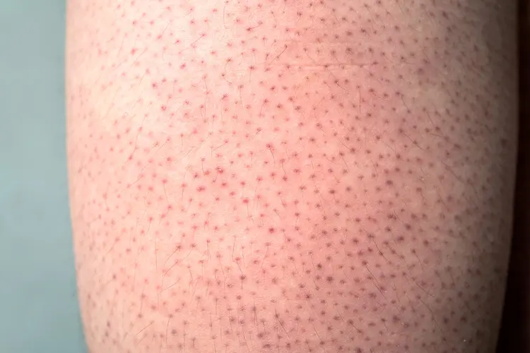 photo of  Keratosis pilaris on leg