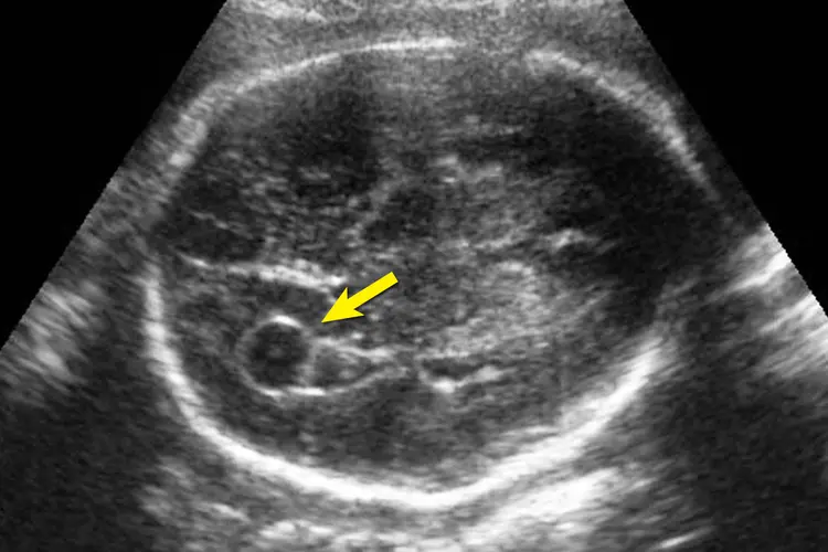 ultrasound of choroid plexus cyst