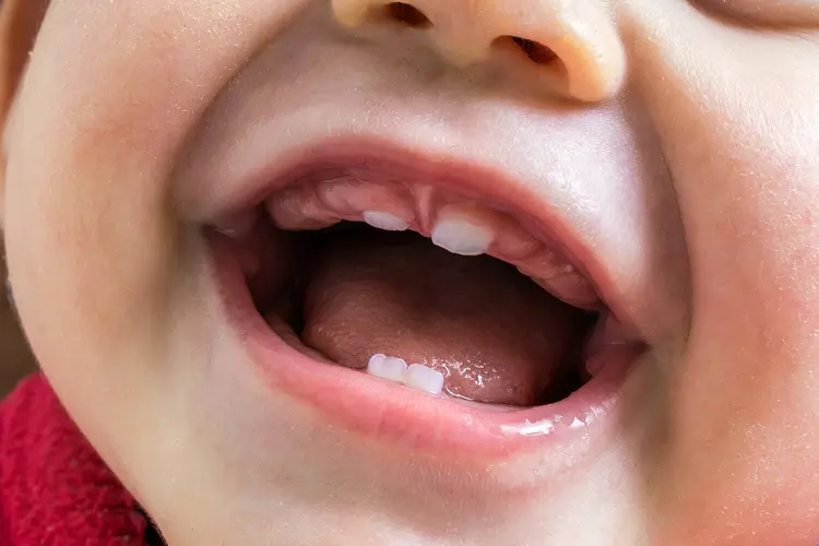 photo of lip tie