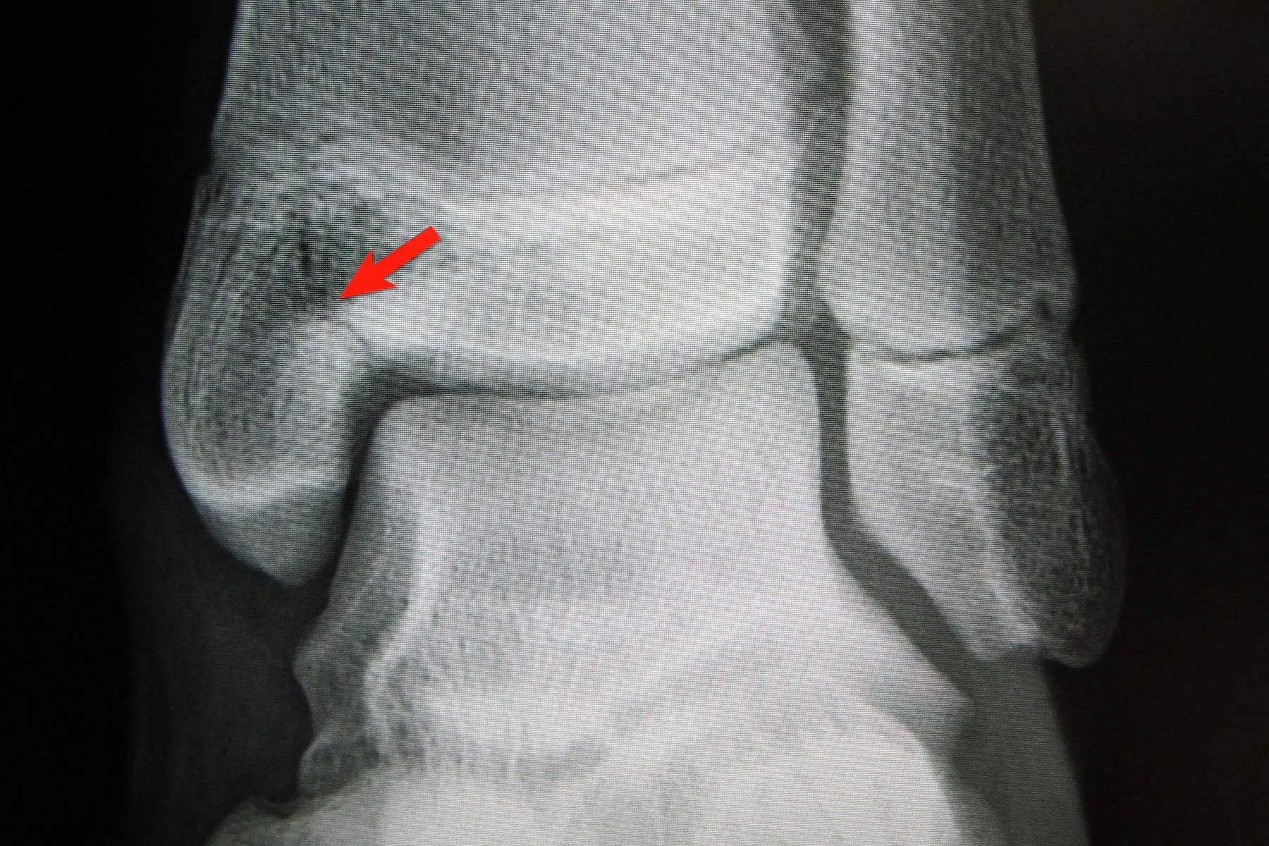 What Is A Salter Fracture