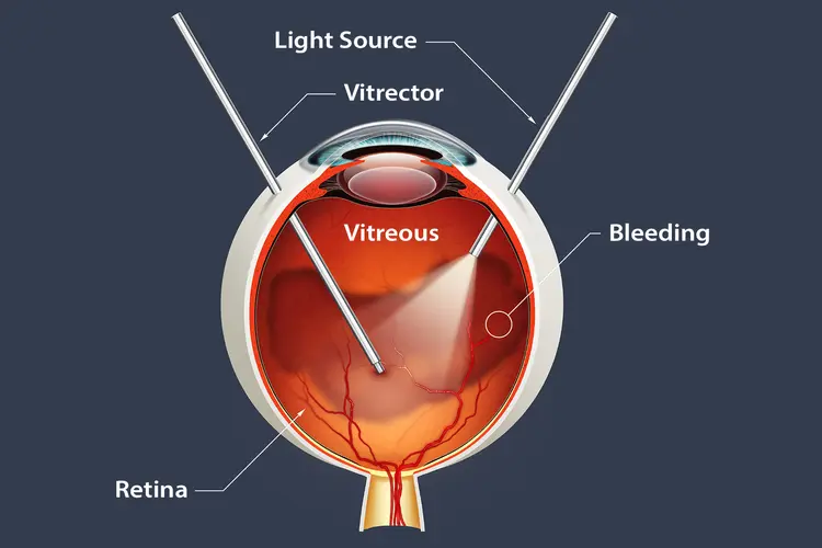 illustration of vitrectomy