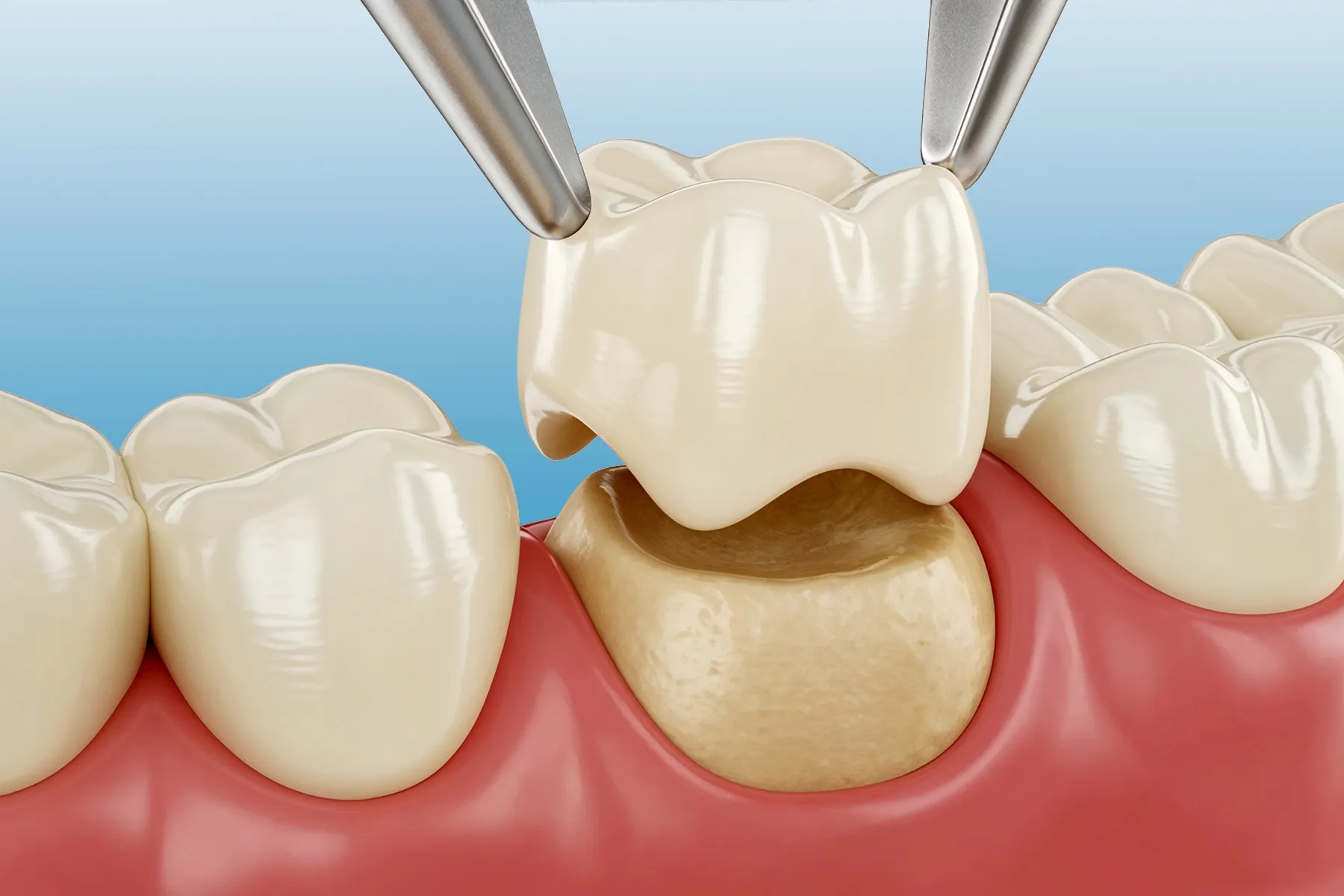 Zirconia Dental Crowns