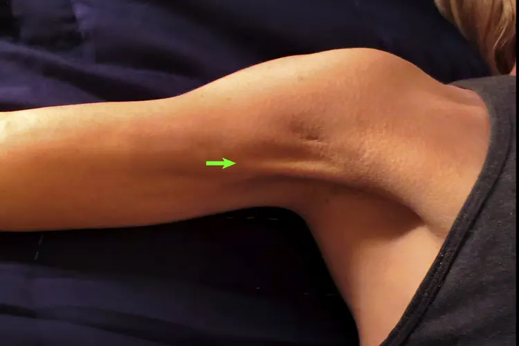 photo of cording in the armpit following breast cancer surgery