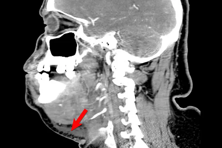 photo of Ludwig’s angina