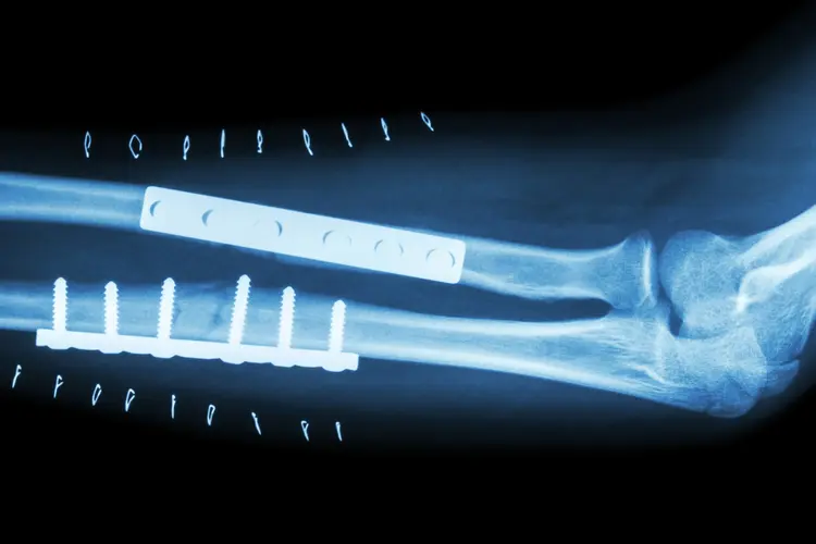 X-ray of broken bones in arm mended with plates and screws; orif surgery 