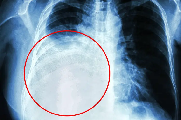 photo of X-ray revealing pleural effusion