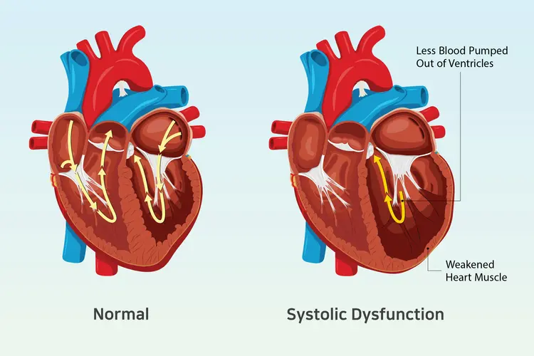 illustration of normal heart vs systolic dysfunction