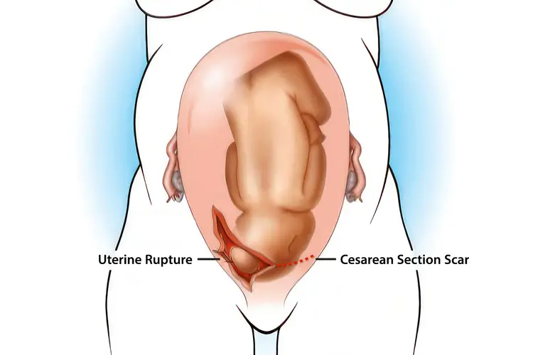 illustration of uterine rupture from a cesarean section scar, the baby's head is pressing out of the rupture on the lower right of the person's belly