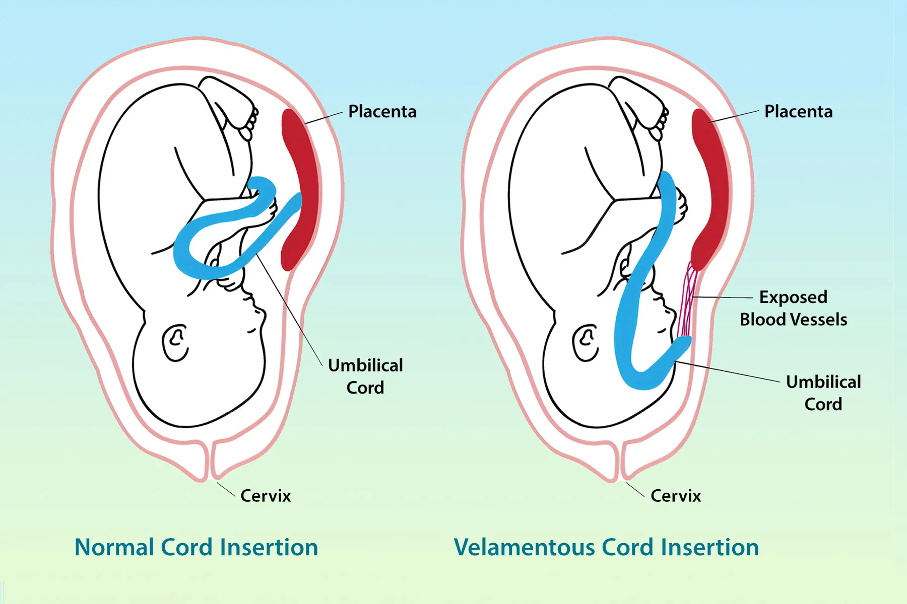 velamentous-cord-insertion-risks-diagnosis-management