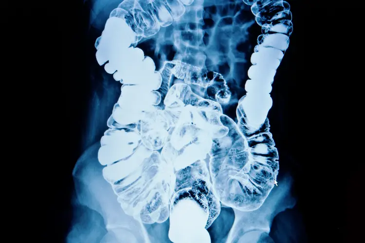 MRI scan of man's colon, showing when a soap suds edema could be appropriate