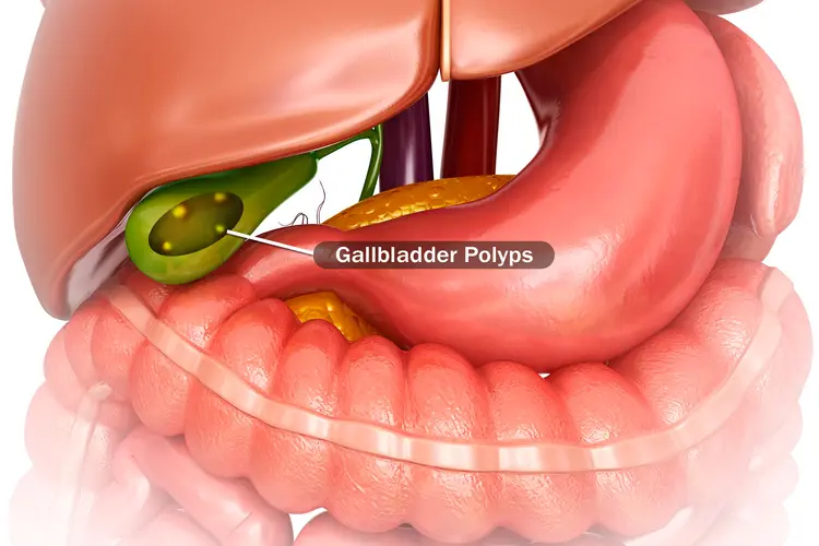 photo of gallbladder polyps