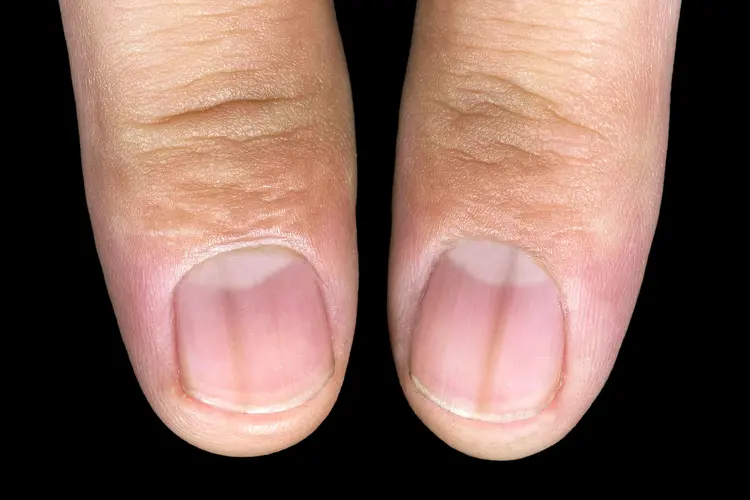 photo of two thumbnails with longitudinal melanonychia