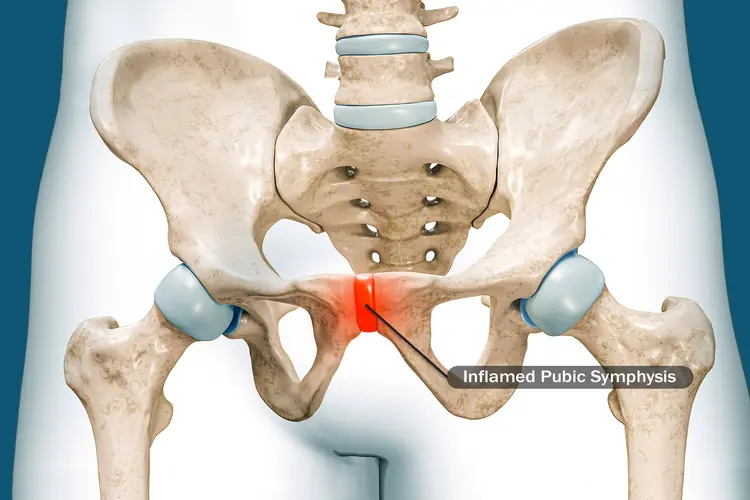 photo of osteitis pubis
