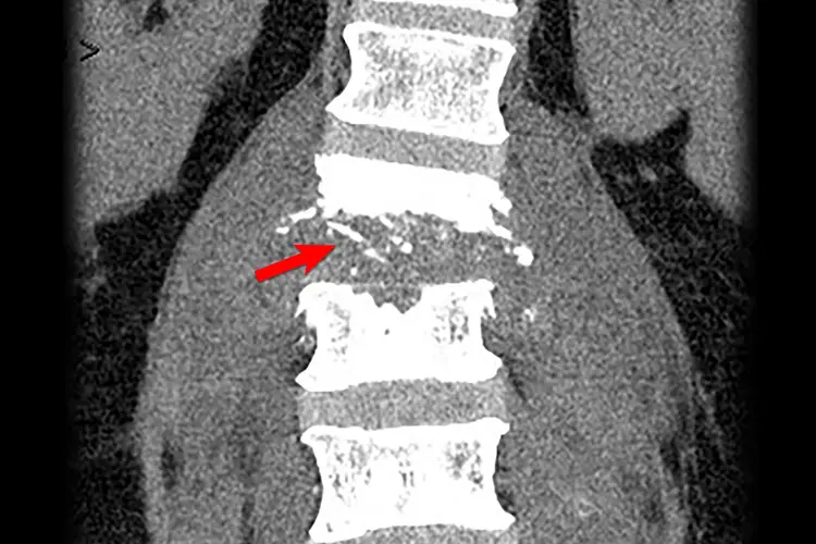 photo of spinal infection CT scan