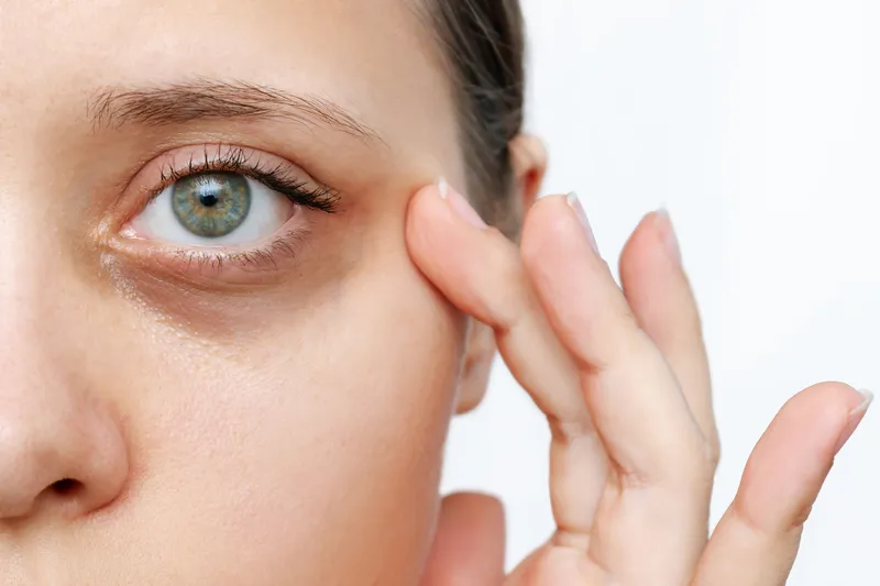 Help! I Have Dark Circles Under My Eyes!