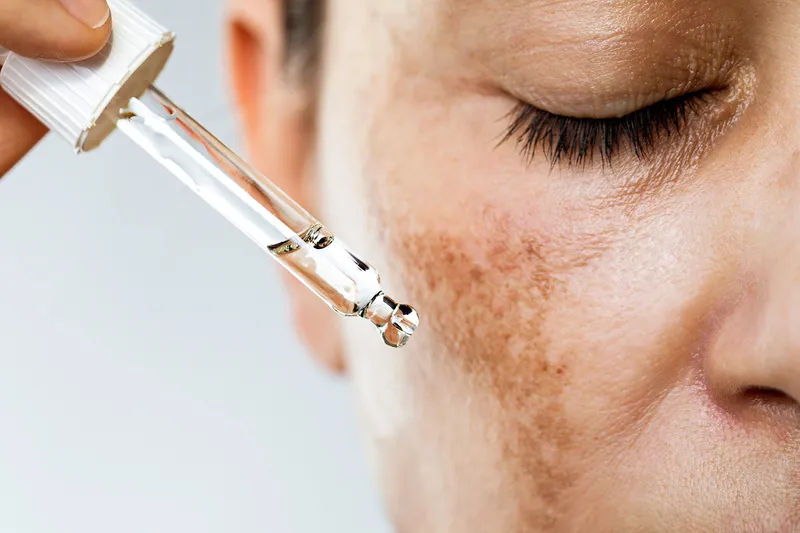 What Is Hyperpigmentation, and What Can I Do About It?
