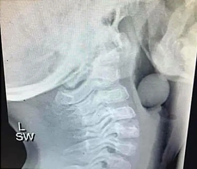 xray of grape in throat