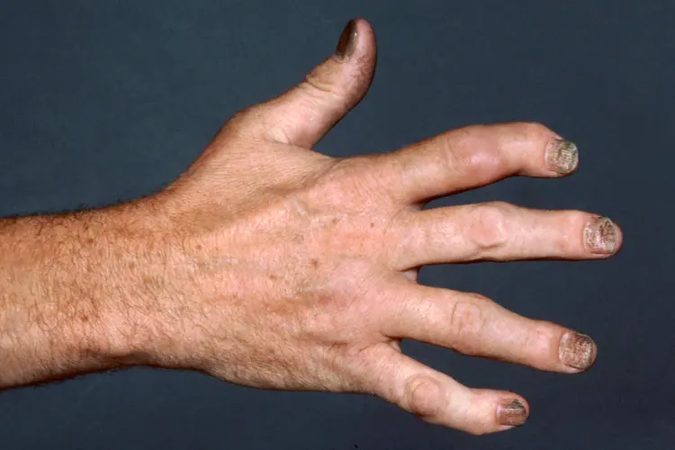 photo of hand displaying psoriatic arthritis