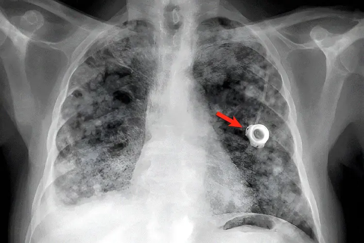 A photo of a scan showing right-sided pleural effusion and pulmonary and pleural metastases