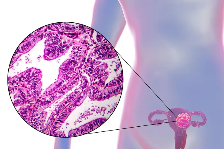 photo of endometrial cancer