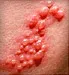 Herpes Zoster Causes Urinary Retention in 10-Year-Old Girl