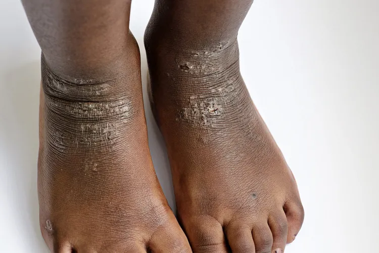 photo of eczema on child's legs