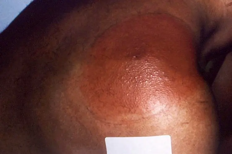photo of Lyme disease